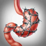 Imodium for Diarrhoea: What You Should Know